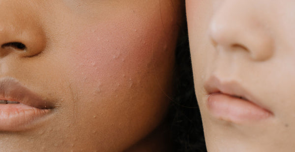 Image Poussée de boutons après l'été : que faire ?