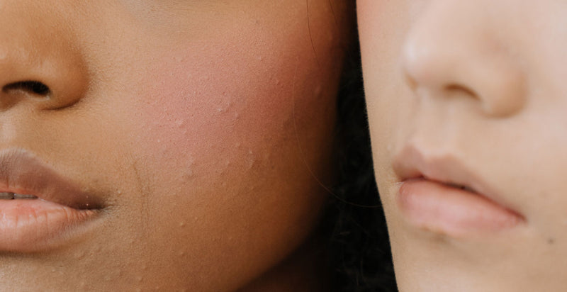 Poussée de boutons après l'été : que faire ?