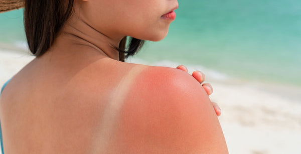 Image Comment soulager un coup de soleil qui gratte ?