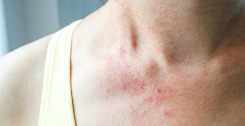 Comment atténuer naturellement mon eczéma sur le visage ?