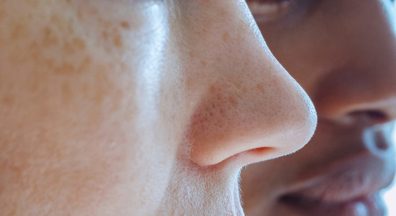 Faut-il se débarrasser des filaments sébacés sur le nez ?