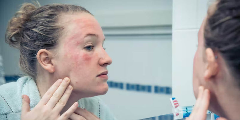 Psoriasis sur le visage : comment le soulager naturellement ?