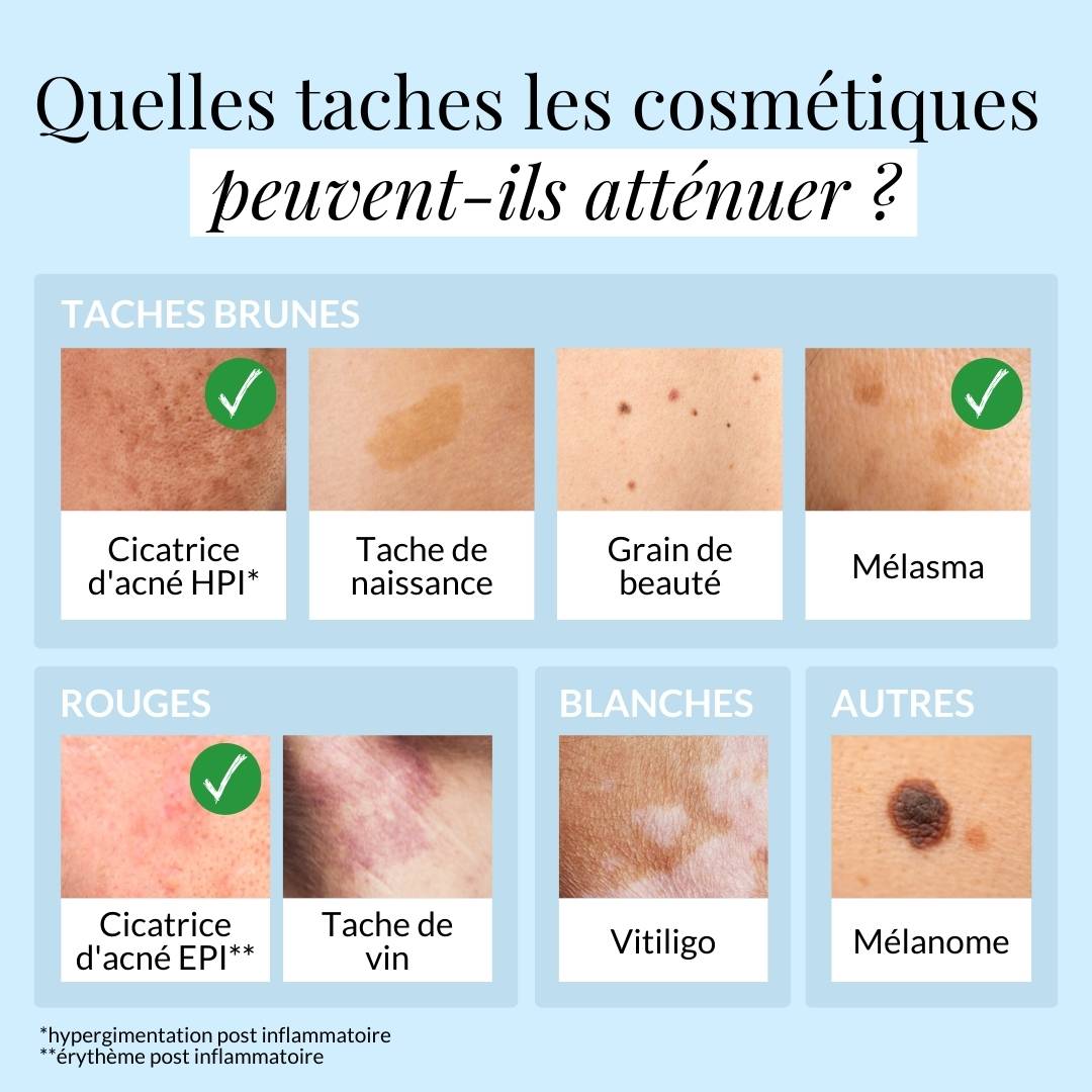 Les taches qui peuvent s'atténuer avec les cosmétiques