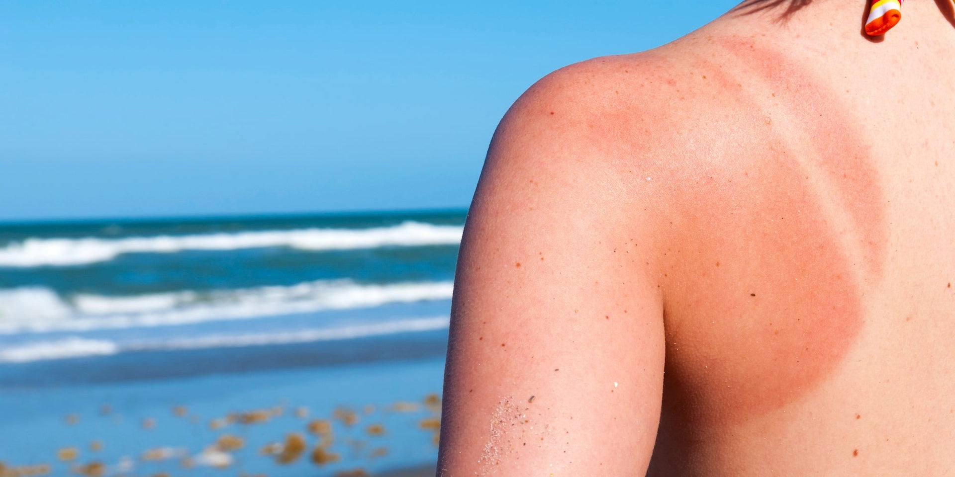 Quels sont les meilleurs remèdes naturels aux coups de soleil ?