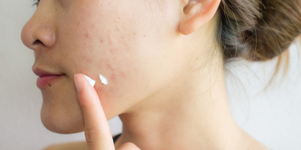 Image Appliquer du dentifrice sur un bouton : bonne au mauvaise idée ?