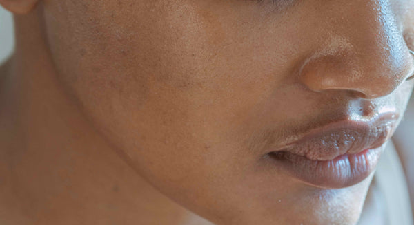 Image Peau grasse : 6 astuces qu'on aurait aimé connaître plus tôt !