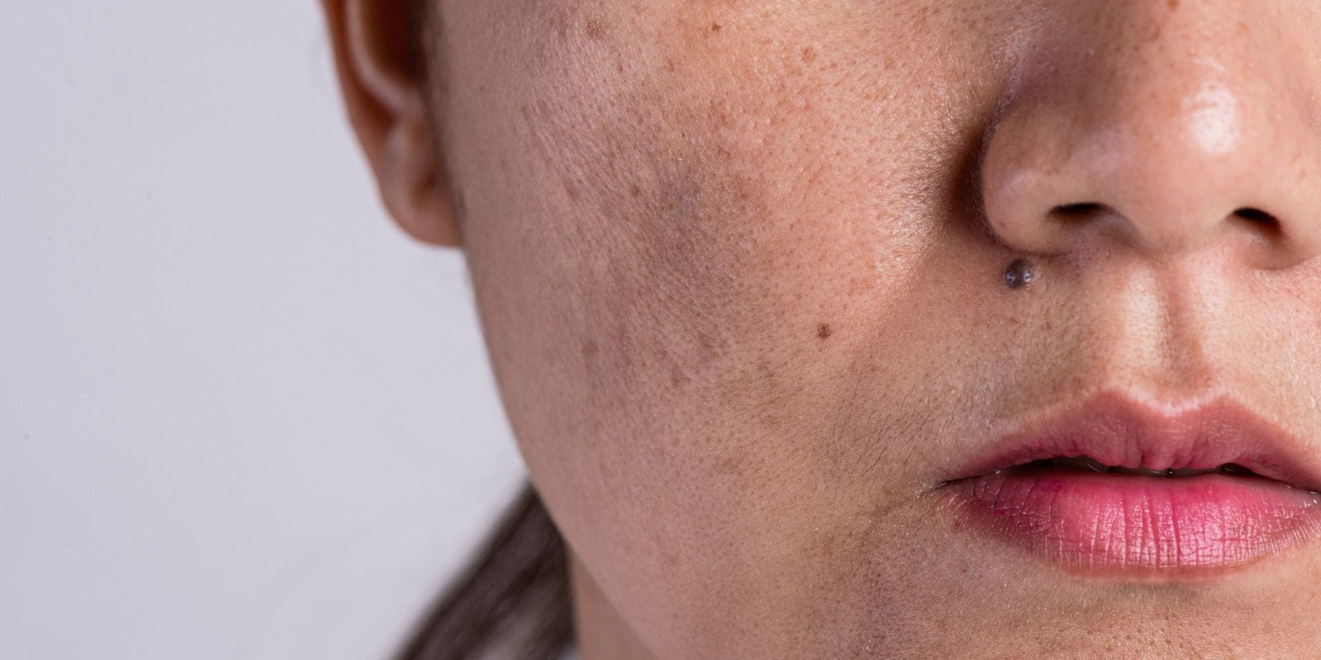 Tache brune après un bouton : comment s'en débarrasser ?