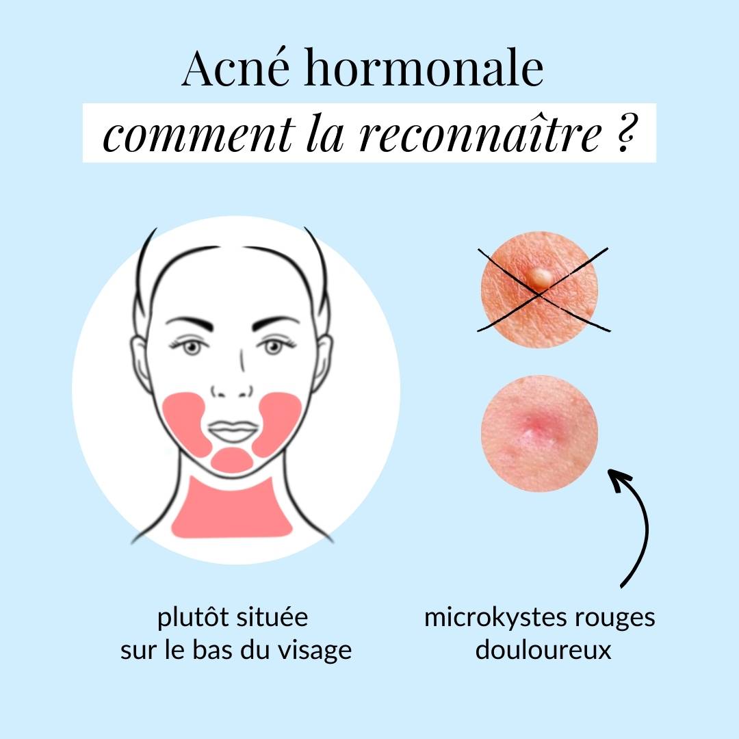 Comment reconnaître l'acné hormonale ?
