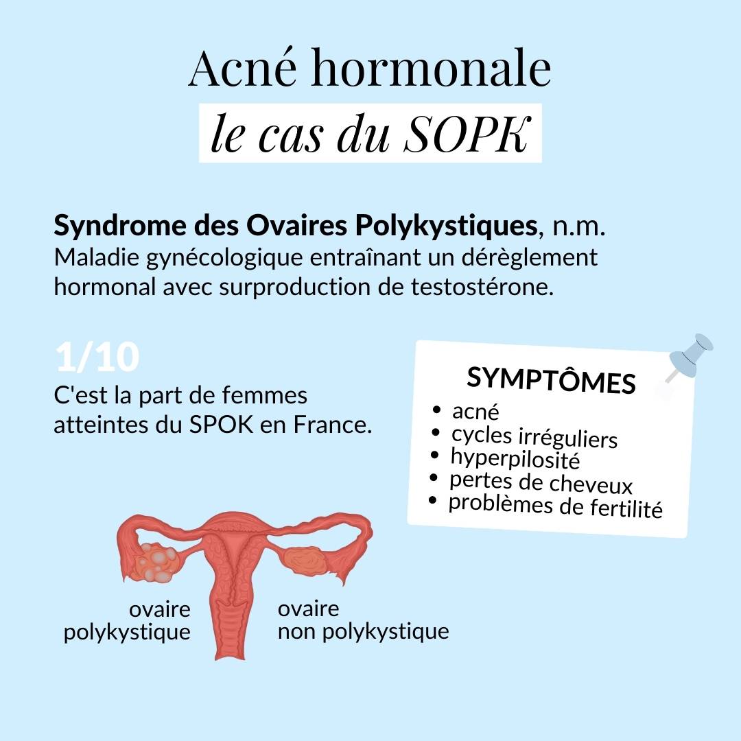 L'acné hormonale et le cas du SOPK