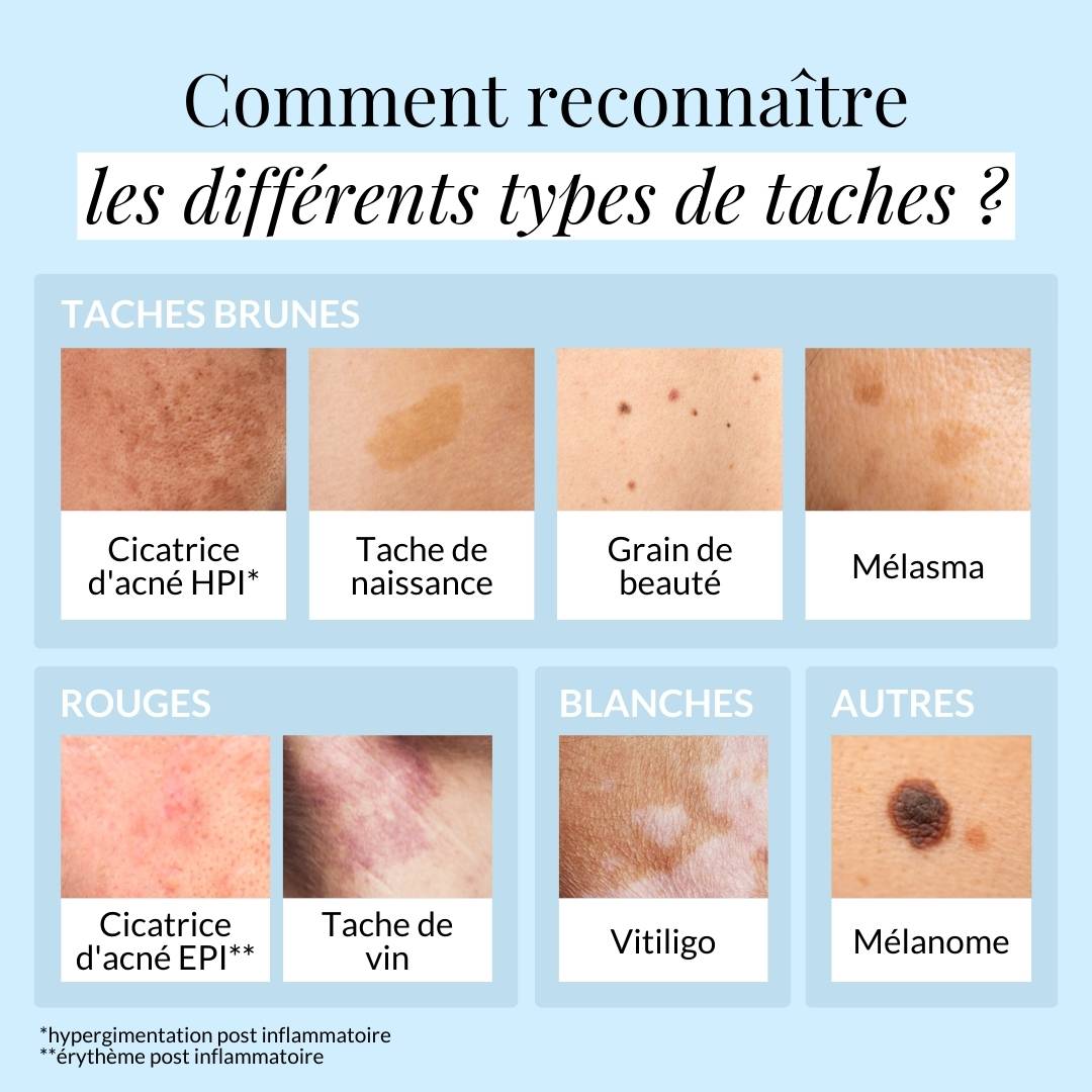 Les différents types de taches de la peau